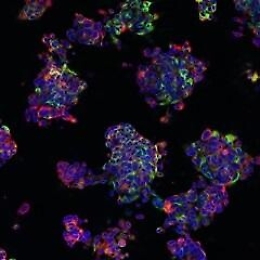 Staminali: cerebrali contro sclerosi multipla, trattati 3 pazienti italiani