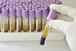 L'analisi ultra molecolare che sostituisce la biopsia chirurgica nel tumore al colon