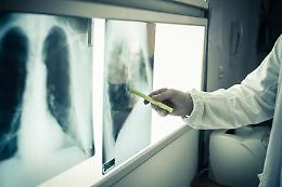 Agenas, nel 2021 interventi tumore tornati a livelli preCovid