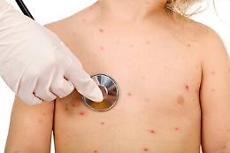 Morbillo, a Catania torna l'allarme: otto casi in dieci giorni