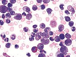Leucemia mieloide cronica:  malattia non più fatale