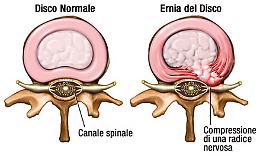 Ernia del disco, stili di vita corretti per prevenirla: validi aiuti da un manipolatore e dalle medicine