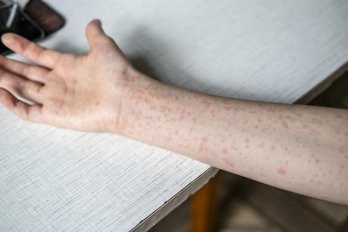 Allarme morbillo al concorso per la magistratura: scatta l'allerta in Sicilia, sotto la lente i dati sulle vaccinazioni
